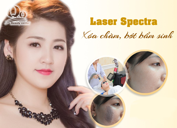 Xoá chàm bớt bằng Laser